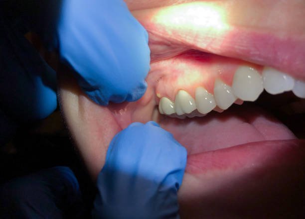 Best Emergency Treatment for Oral Infections in North Industry, OH